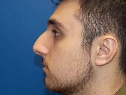 Rhinoplasty Before & After Patient #4084
