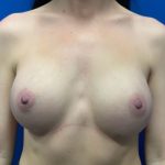 Breast Augmentation Before & After Patient #4137