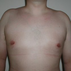 Gynecomastia Before & After Patient #4017