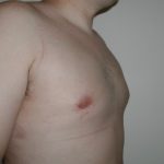 Gynecomastia Before & After Patient #4017