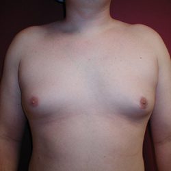 Gynecomastia Before & After Patient #4017
