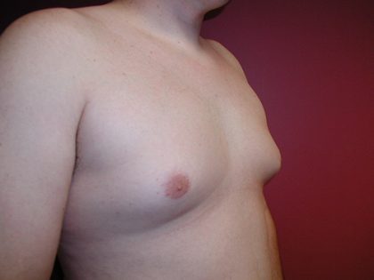 Gynecomastia Before & After Patient #4017