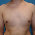 Gynecomastia Before & After Patient #4003