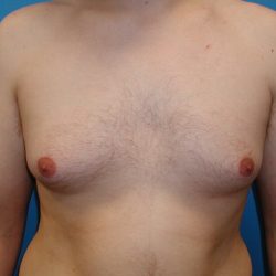 Gynecomastia Before & After Patient #4003