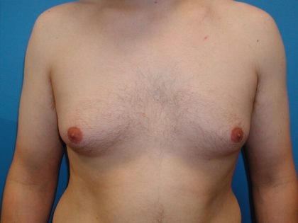 Gynecomastia Before & After Patient #4003