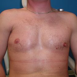 Poland Syndrome Before & After Patient #3992
