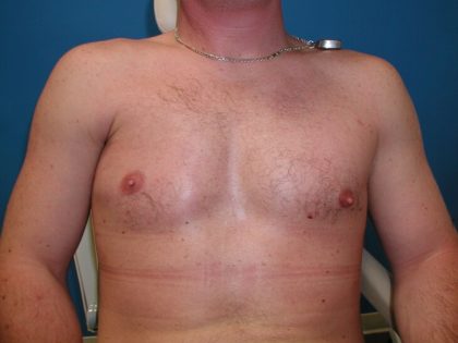 Poland Syndrome Before & After Patient #3992