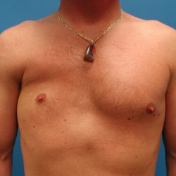 Poland Syndrome Before & After Patient #3992