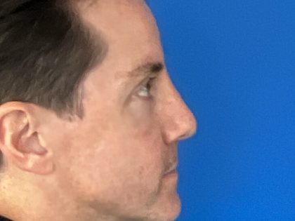 Rhinoplasty Before & After Patient #4113
