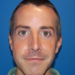 Rhinoplasty Before & After Patient #4113