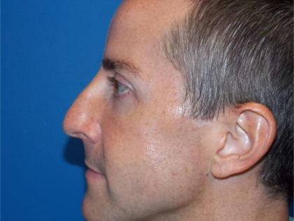 Rhinoplasty Before & After Patient #4113
