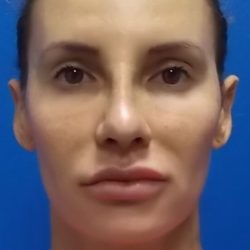 Rhinoplasty Before & After Patient #4126