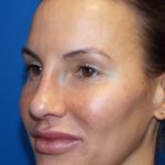 Rhinoplasty Before & After Patient #4126
