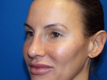 Rhinoplasty Before & After Patient #4126