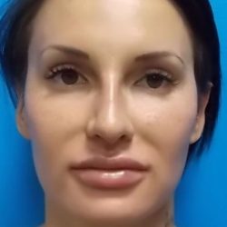 Rhinoplasty Before & After Patient #4126