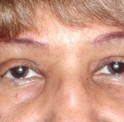 Upper Blepharoplasty Before & After Patient #3877