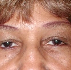 Upper Blepharoplasty Before & After Patient #3877