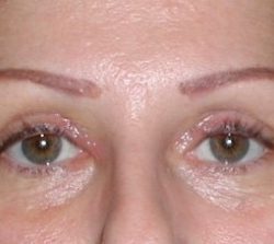 Upper Blepharoplasty Before & After Patient #4073