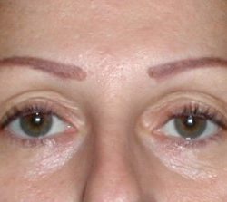 Upper Blepharoplasty Before & After Patient #4073