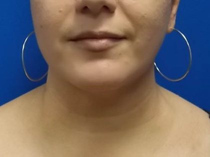 Submental Liposuction Before & After Patient #4287