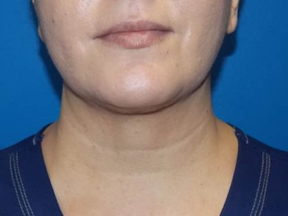 Submental Liposuction Before & After Patient #4287