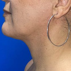 Submental Liposuction Before & After Patient #4287