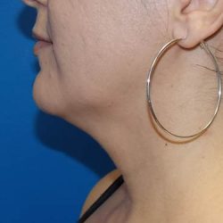 Submental Liposuction Before & After Patient #4287