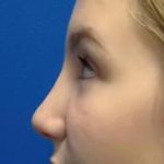 Rhinoplasty Before & After Patient #4372