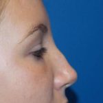 Rhinoplasty Before & After Patient #4372