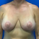 Breast Lift & Augmentation Before & After Patient #4316