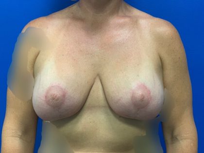 Breast Lift & Augmentation Before & After Patient #4316