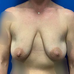 Breast Lift & Augmentation Before & After Patient #4316