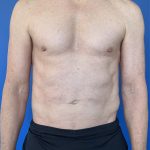 Liposuction Before & After Patient #4335