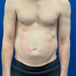 Liposuction Before & After Patient #4335