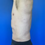 Liposuction Before & After Patient #4335