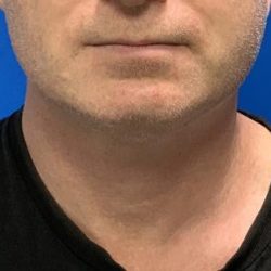 Submental Liposuction Before & After Patient #4349