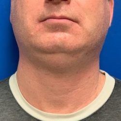 Submental Liposuction Before & After Patient #4349