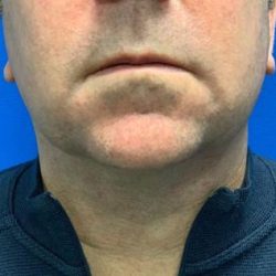 Submental Liposuction Before & After Patient #4366