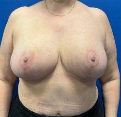 Breast Reduction Before & After Patient #4357