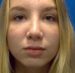 Rhinoplasty Before & After Patient #4372