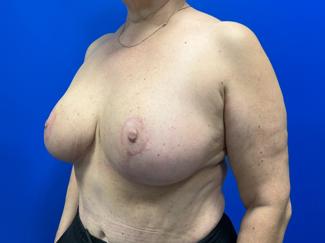 Breast Reduction Before & After Patient #4357