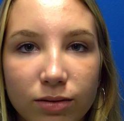 Rhinoplasty Before & After Patient #4372