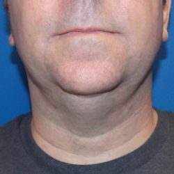 Submental Liposuction Before & After Patient #4366