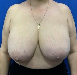 Breast Reduction Before & After Patient #4357