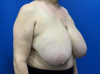 Breast Reduction Before & After Patient #4357