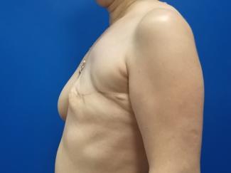 Tissue Expander To Implant Breast Reconstruction Before & After Patient #4492