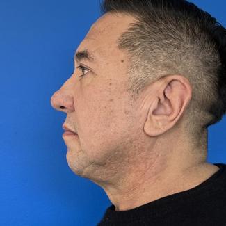 Chin Implant Before & After Patient #4476