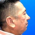 Chin Implant Before & After Patient #4476