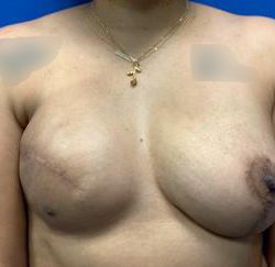 Tissue Expander To Implant Breast Reconstruction Before & After Patient #4399