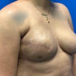 Tissue Expander To Implant Breast Reconstruction Before & After Patient #4399